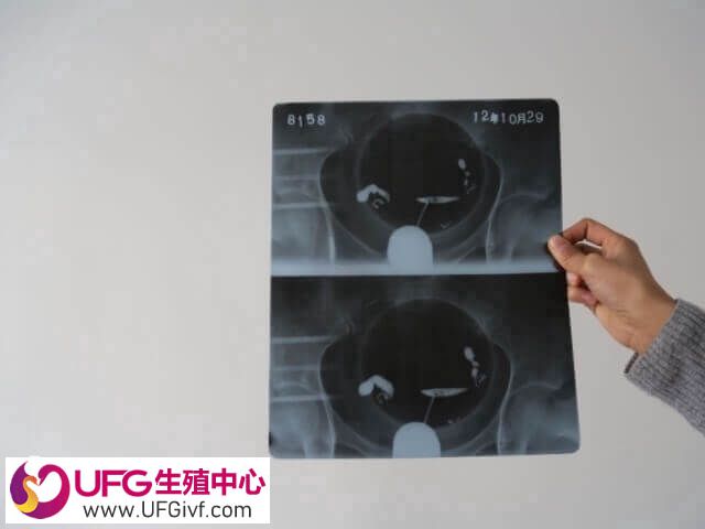 宫颈疾病可能导致出血
