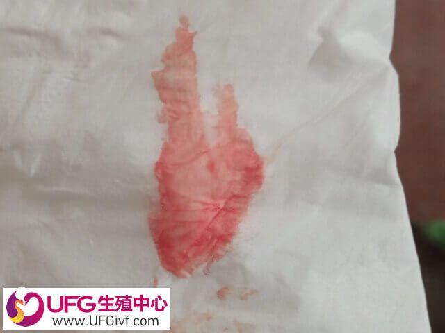 试管移植后出血可能是激素变化所致