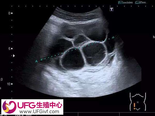 卵巢过度刺激会引起腹水