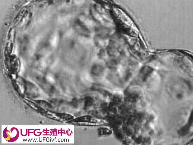 一个质量好的囊胚移植后会裂变成单卵双胞胎吗？